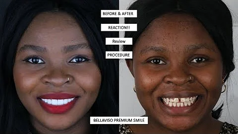 Hollywood Smile in Dubai | Before & After Smile Makeover Transformations
