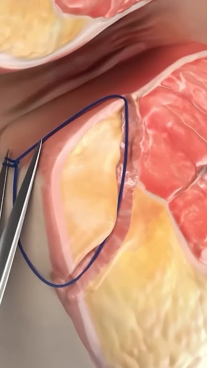 Laser Closure of Fistula Tract (FiLaC)   Video credit: SurgMedia (Youtube.com)