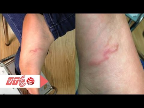 Đề phòng giun lươn chu du trong cơ thể | VTC