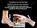 Ganglion Cyst Of The Foot - Everything You Need To Know - Dr. Nabil Ebraheim