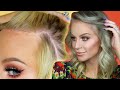 My Hairline Surgery Results | Gigi