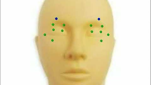 AIOC 2017 - Jaipur - VT270 - Pearls for Botulinum Toxin Injection i............