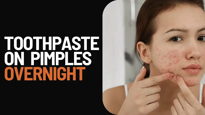 Toothpaste on Pimples Overnight: 5 Best Treatment Options
