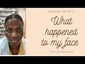 WHAT HAPPENED TO MY FACE? | CHEMICAL PEEL | COSMETIC SURGERY