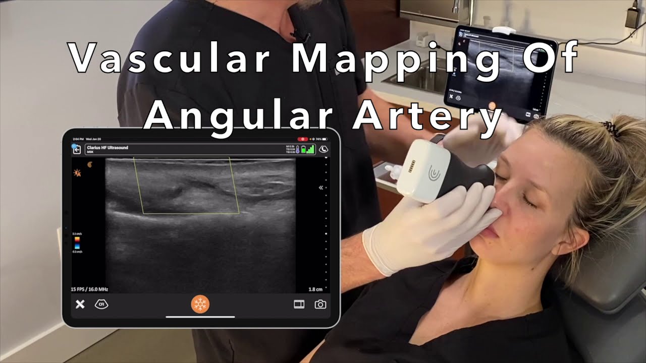 Color Doppler Ultrasound Vascular Mapping For Facial Filler Injection Safety YouTube