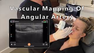 Color Doppler Ultrasound Vascular Mapping For Facial Filler Injection Safety