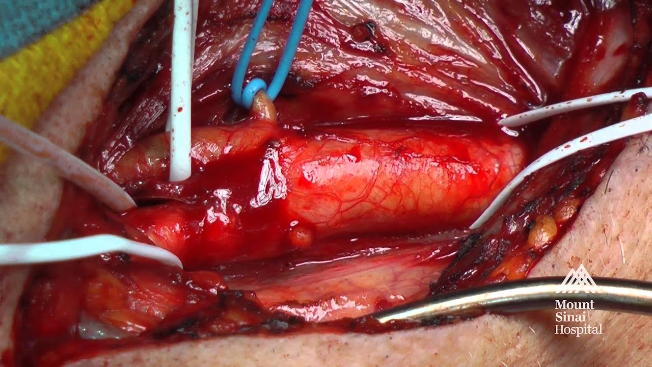 Osseointegration of the Tibia After Primary Amputation - Live Surgery