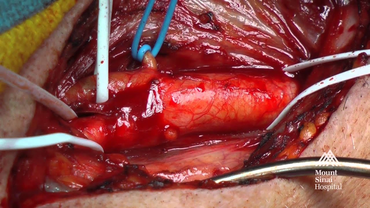 endarterectomy