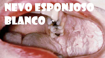 Quais são os aspectos clínicos do Leucoedema?