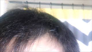 Apple Poly Procyanidin Treatment For Hair Loss - November 2017