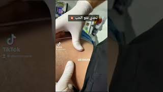 تحدي فقع حب الشباب 🥳🔥 شبكة عيادات الدكتور محمد غره للتجميل   DOCTORGARA -ACNE treatment -الطبي