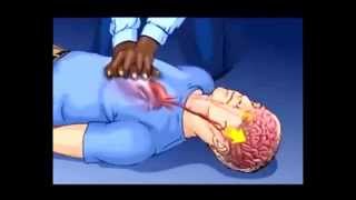 The Continuous Chest Compression CPR