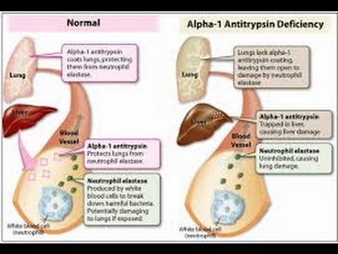 Alpha 1 Antitrypsin Deficiency