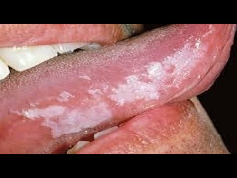 Leukoplakia With Moderate Dysplasia: Discussing My Mouth Cancer Scare