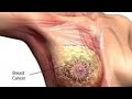 Meaning Of Breast Cancer