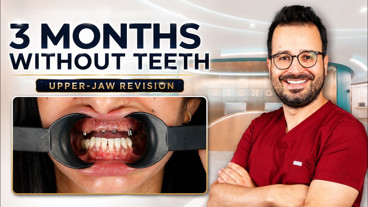 Poorly Positioned Dental Implants: Upper-Jaw Revision With Next-Day Temporary Teeth | Istanbul