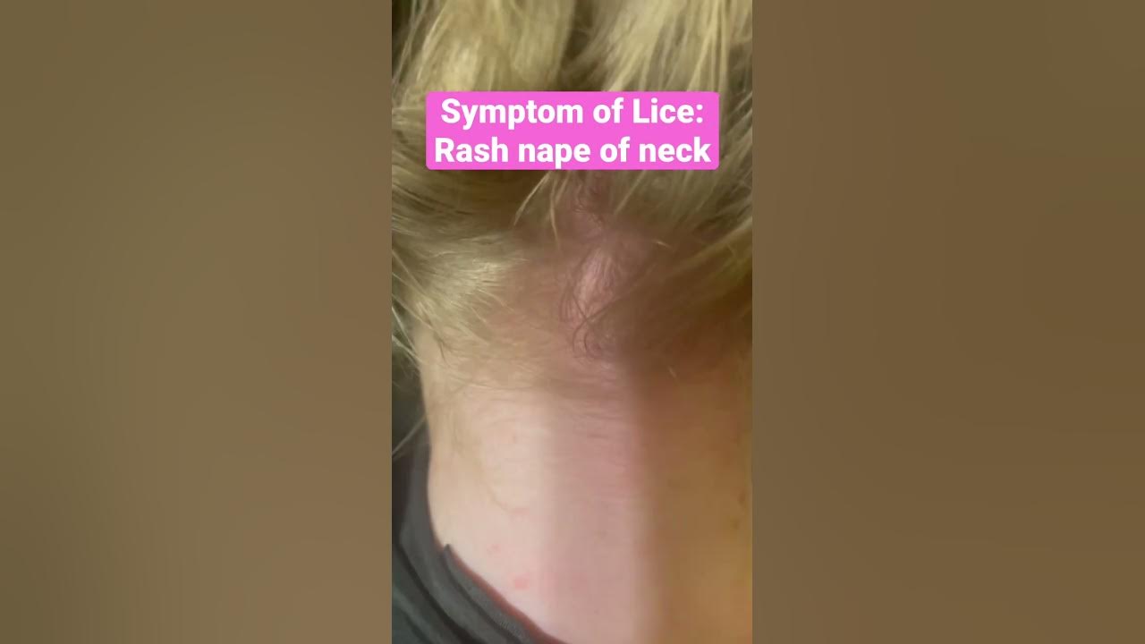 Symptom Of Lice Rash At Nape Of Neck L Lice Removal Service Stacey