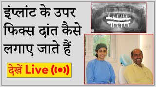 इंप्लांट के उपर फिक्स दांत कैसे लगाए जाते हैं देखें ( LIVE ) | Seraphic Dental, Indore