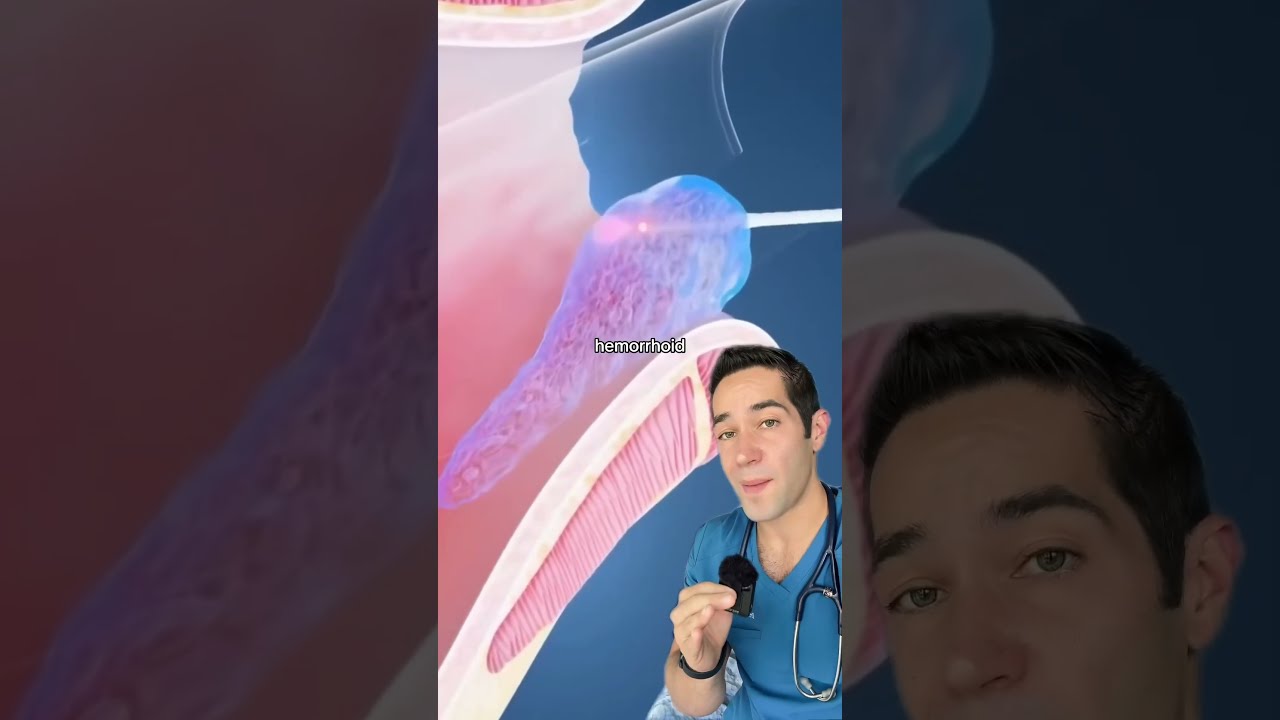 How Doctors Remove Hemorrhoids