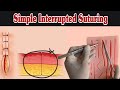 Simple interrupted suturing  simple  suture procedure