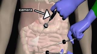 Laparoscopic Appendectomy - Animation by Cal Shipley, M.D. screenshot 4