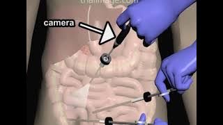Apendektomi Laparoskopi - Animasi oleh Cal Shipley, MD