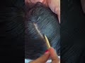 #fypviralシ #statisfying #lice #hair #LiceOnHead #liceremoval  #india  #xyzbcafyp #licecomb  #kutu