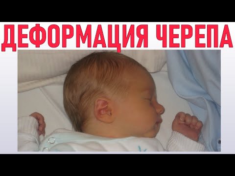 ДЕФОРМАЦИЯ ЧЕРЕПА У НОВОРОЖДЕННОГО РЕБЕНКА | Насколько опасна деформация черепа у младенцев