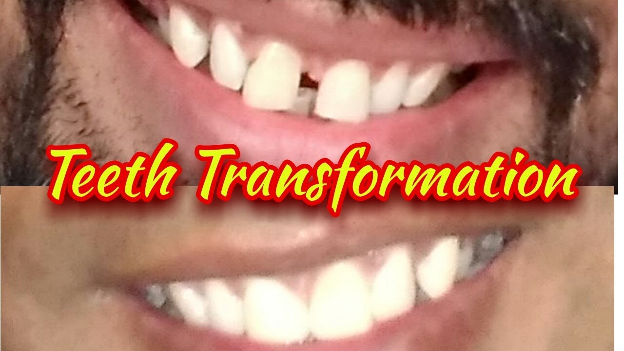 My Teeth Transformation Dental Bonding YouTube