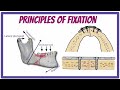 ORAL SURGERY | PRINCIPLES OF FIXATION IN MAXILLOFACIAL TRAUMA | Compression Osteosynthesis