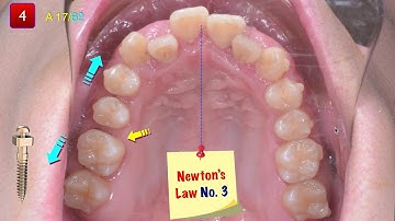 Screws for fixed appliances and aligners 2020 AAO Part I｜【Chris Chang Ortho】CC549