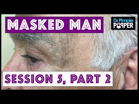 The Masked Man, Dr Pimple Popper, And NikkieTutorials: Blackhead Extractions! Session 5, Part 2