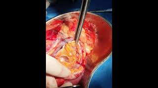 استئصال جذري للكلية بسبب ورم خبيث فيها/  راكرنا ريشەیێ یا گولجیسکێ/ Radical Nephrectomy