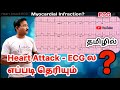 Heart attack ecg in tamil  mi myocardial infarction  anterior inferior  lateral wall mi ps tamil