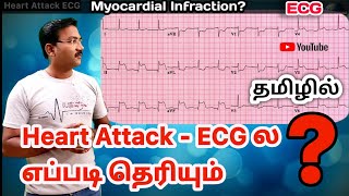 Heart attack ECG in tamil | MI myocardial infarction | anterior Inferior & lateral wall MI |ps tamil