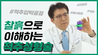 척추압박골절 치료엔 척추성형술?(feat.뼈시멘트)