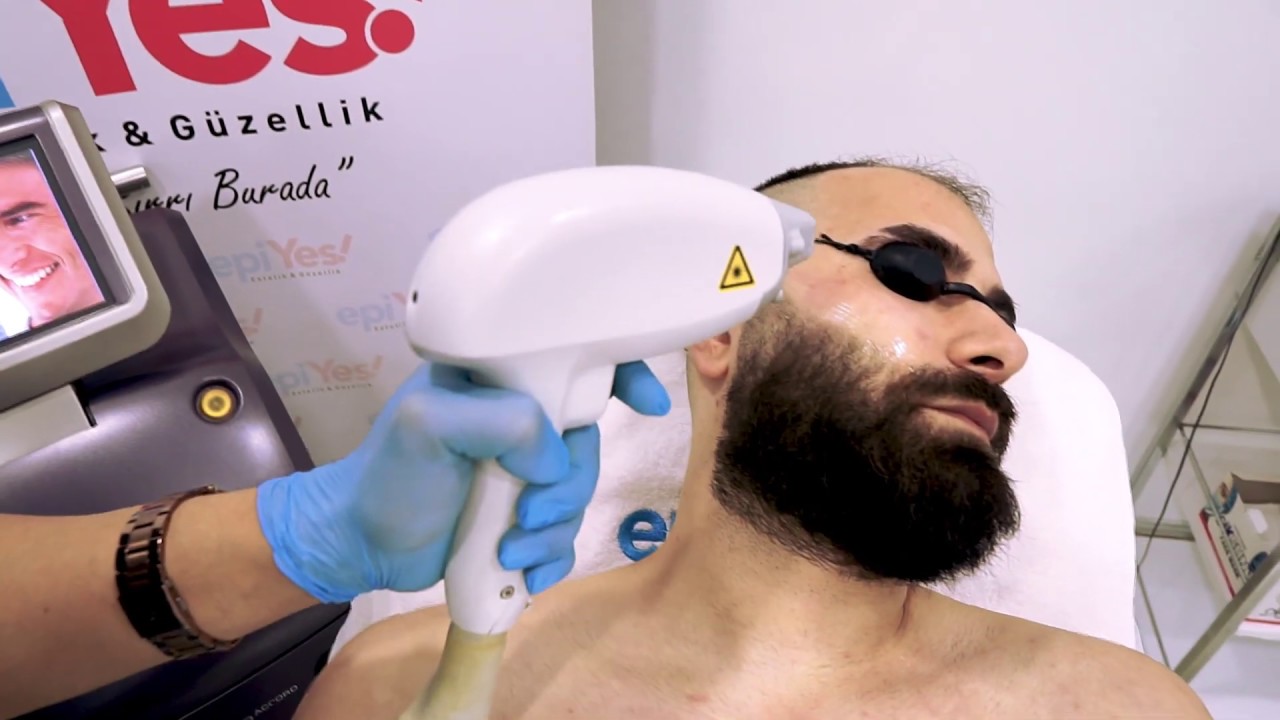 Erkek lazer epilasyon