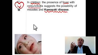 Kawasaki disease (Quick note) #cme #internal_medicine #doctor #usmle #medicalcollege #محاضرات_باطنة screenshot 5