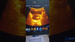 hemoperitoneum. #hemoperitneum. #accident. #accidentcase. ##blood.. #injury. #bleeding. #ultrasound