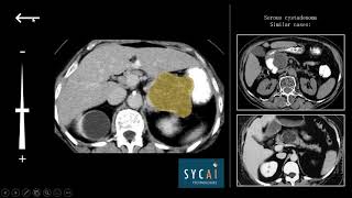 Sycai Medical Demo - Classifying pancreatic cysts through AI