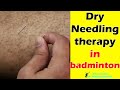 Dry needling therapy in badminton #badminton