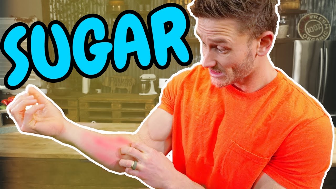 THIS is What Eating SUGAR Does to Your Skin! YouTube