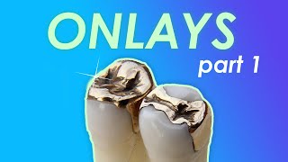 Onlay Case Selection  Ace Courses Webinar Summary