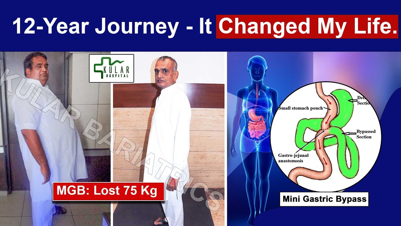 12-Year Journey with MGB: Lost 75 Kg – It Changed My Life. 