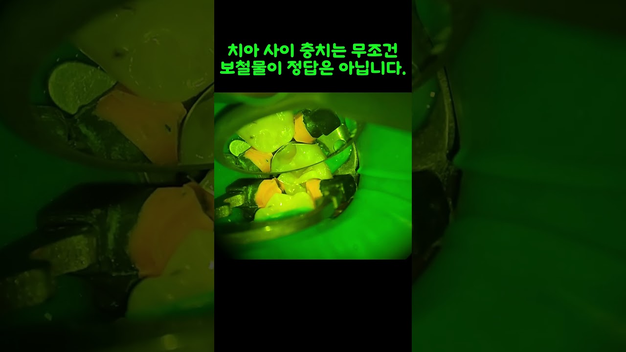 치아 사이 충치는 무조건 인레이가 정답은 아닙니다. #최소삭제