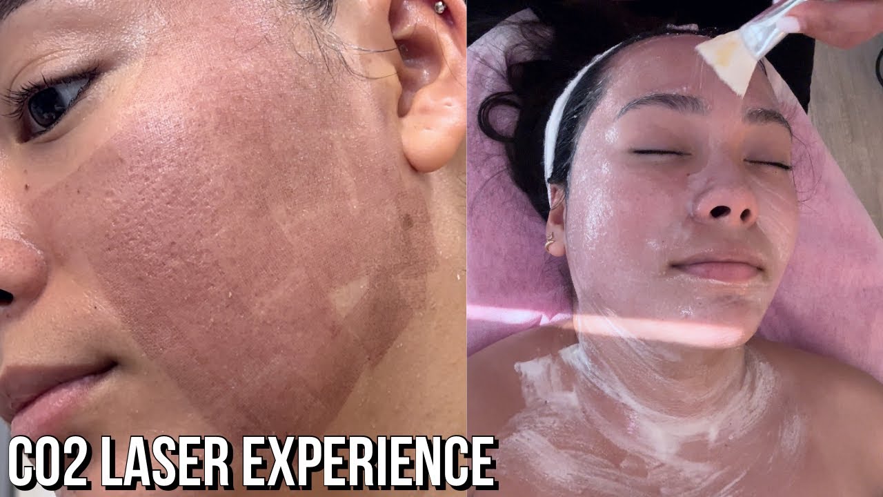 Восстановление после CO2-лазера! + Обновление за 1 месяц