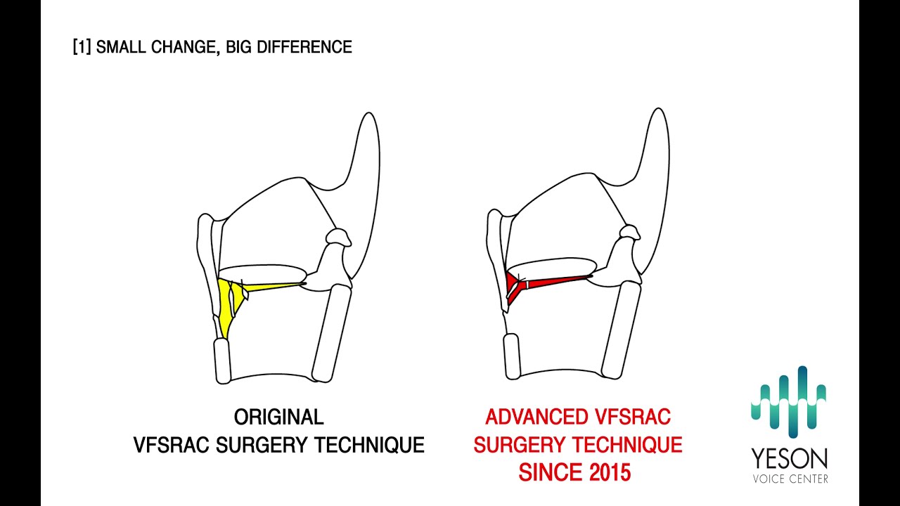[Yeson Voice Center] ADVANCED PHONOLOGICAL TECHNOLOGY OFYESON’S VOICE FEMINIZATION SURGERY (VFSRAC)