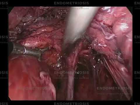 Caso 2 de endometriosis profunda: cirugia laparoscopica avanzada