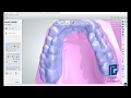 FÉRULA DE MICHIGAN CAD/CAM IMPRESIÓN 3D - De las Casas Prótesis dental