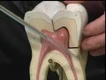 Hipersensibilidad dental. T.11